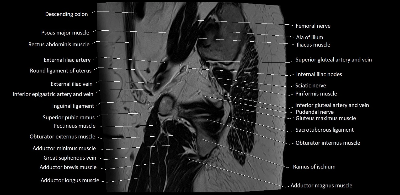 Sagittal cross sectional anatomy of female pelvis (MRI 3T) image 38.webp